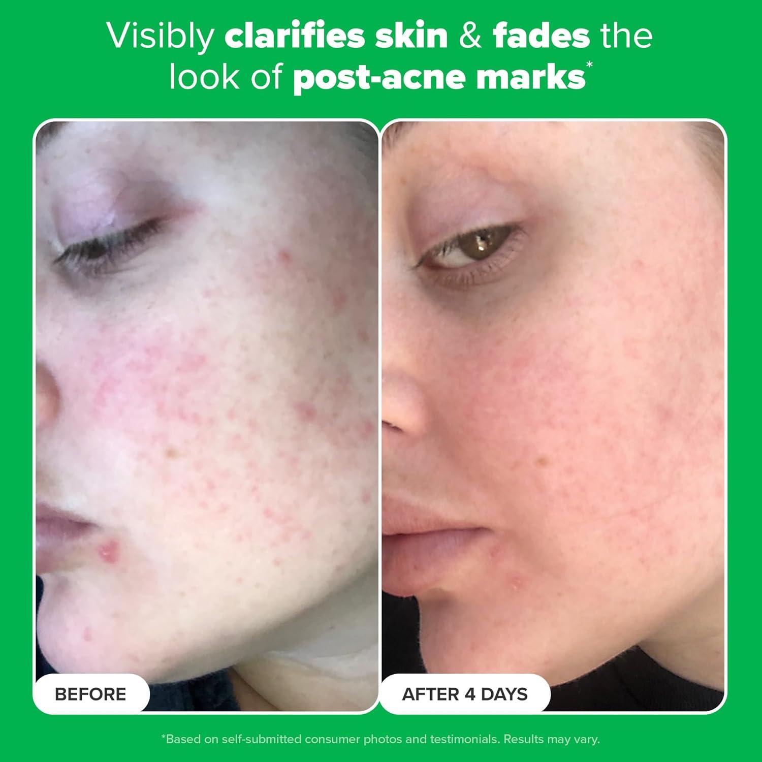 image:imagePaulas Choice BOOST 10 Azelaic Acid Booster Cream Gel Face Serum with Salicylic Acid OilFree Skin Brightening Serum for Face FragranceFreeTravel Size 017 Fl Oz