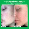 Paula’s Choice BOOST 10% Azelaic Acid Booster Cream Gel Face Serum with Salicylic Acid, Oil-Free Skin Brightening Serum for Face, Fragrance-Free(1 Fl Oz (Pack of 1))
