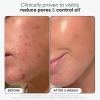 Paula’s Choice SKIN PERFECTING 2% BHA Liquid Exfoliant with Salicylic Acid, Facial Polish for Enlarged Pores, Wrinkles & Fine Lines, Suitable for Blackhead-Prone Skin, Fragrance-Free(Pads – 10 Count)